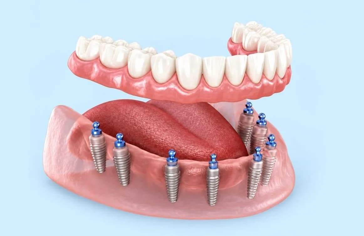 Alt çenede birden fazla implantın üzerine takılan protezi gösteren 3 boyutlu model