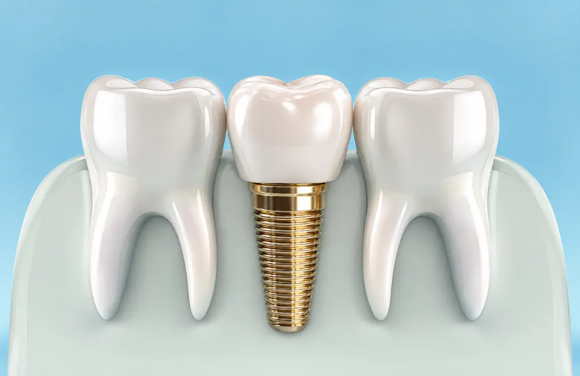 İki diş arasındaki boşluğa yerleştirilmiş, üzerinde porselen kuron bulunan diş implantının model görseli