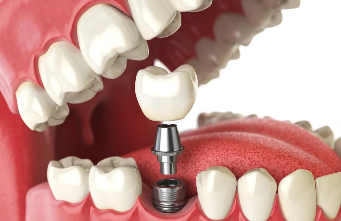 Çene kemiğine yerleştirilen implant gövdesi, bağlantı parçası ve üzerine takılacak porselen protez dişin ayrı ayrı gösterildiği 3 boyutlu model